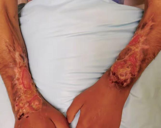 Image of krokodil effects flesh eating drug. The unsanitary conditions and unsterile injection practices associated with krokodil drug use greatly increase the risk of severe infections.