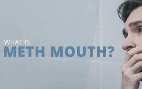 What is meth mouth? Meth mouth pictures.
