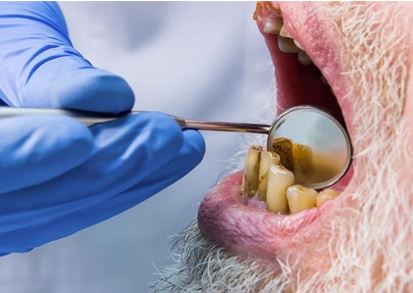 Meth mouth is the dental effects of meth abuse. Individuals experience tooth decay, rotting gums and other side effects that can worsen overtime.