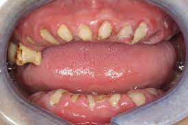 Meth mouth images: Methamphetamine (meth) is a dangerously addictive drug that can have severe health consequences, one of which is "meth mouth." In this meth mouth pic, severe tooth decay has all but destroyed the entire mouth's teeth.