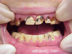 Meth mouth images: The teeth of people addicted to methamphetamines are blackened, stained, rotting, crumbling, and falling apart.  In this meth mouth pic, missing teeth along with severe tooth decay can be seen.