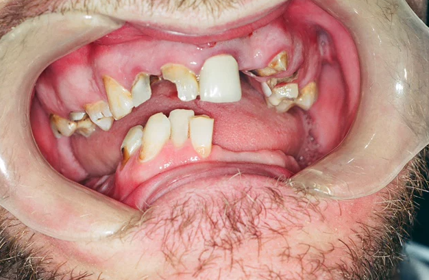 Meth mouth is a common consequence of chronic methamphetamine use, resulting in tooth decay and painful oral tissue inflammation that can progress to complete tooth loss. For more meth before and after pictures of users and before and after crystal meth pictures, visit www.dea.gov.