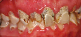 Meth mouth images: The teeth of people addicted to methamphetamines are blackened, stained, rotting, crumbling, and falling apart.  In this meth mouth pic, rotting decay is on virtually all of the teeth can be seen.