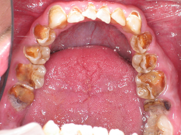 Images of meth mouth: If Meth addiction is continued over a long period of time, the brain begins to rely on its effects and creates a need for its use.  Photos of meth addicts, meth addict images, and meth mouth also portray its physical hazard effects. In this meth moth pic, extreme tooth decay along with rotting yellowing discoloration of the teeth is clearly visible.
