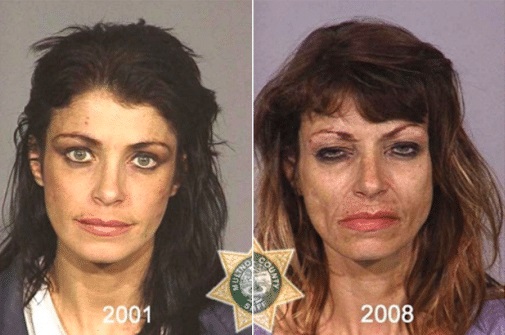Meth addiction pictures. The meth before and after the changeover of this woman over a decade is alarming. She initially portrays early signs of premature aging. For more meth addicts before and after pictures and crystal meth before and after pictures, visit www.dea.gov.