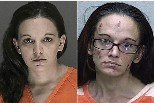 The woman's face in this meth before and after has lost significant youth after a decade of continuous use. Her lack of personal hygiene is evident. She has sores and scars all over her face by age 31. She appears slimmer, is graying, and has a receding hairline. She seems chiseled due to the removal of facial fat and muscle. For more pictures of meth addicts before and after and crystal meth images before and after, visit www.dea.gov.