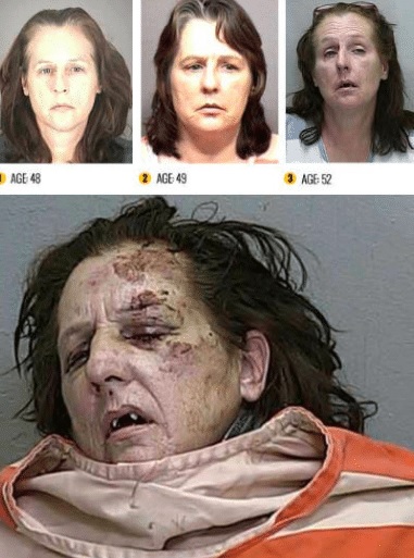Meth is an addictive drug with severe health effects, including stroke and permanent brain damage. It’s also devastating to your dental health and skin. For more meth addicts before and after pictures and crystal meth addicts images, visit www.dea.gov.