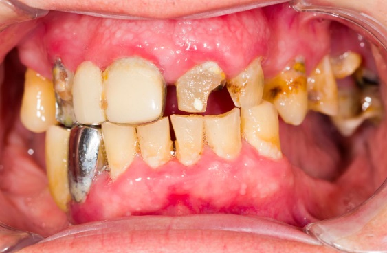 Why Does Meth Rot Teeth: Meth Effects On Teeth - Meth Effects Teeth (Meth Teeth Grinding)