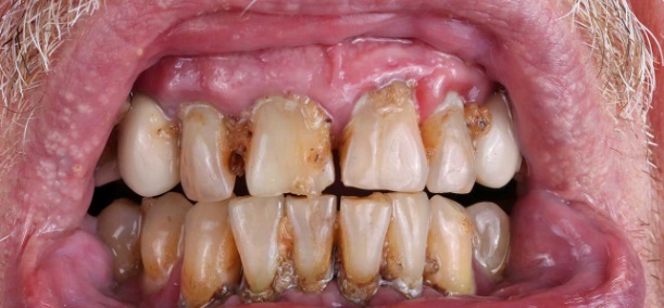 Teeth Meth: Meth Users Teeth - Teeth Of Meth Users (Meth Mouth Teeth Pictures)