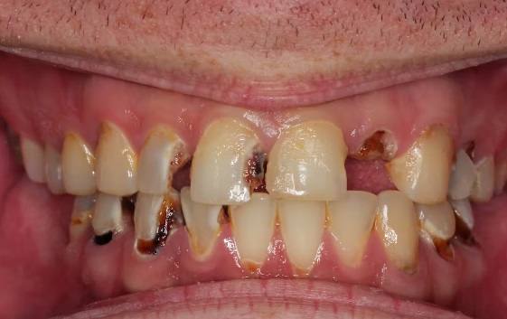 Meth Teeth Pics: Meth Head Teeth - Meth Mouth Pic (Crystal Meth Teeth)