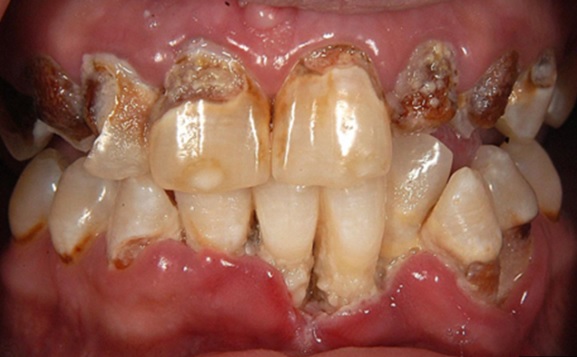 Meth Teeth Pictures: Pictures Of Meth Teeth - Meth Teeth Photos (Meth Mouth Teeth) Meth Addicts Teeth