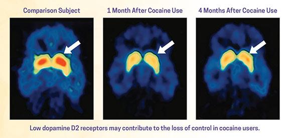 What is cocaine's impact on the brain? Picture above is a Cocaine addict picture of the brain. Source: NIDA. 2020, July 13. Drug Misuse and Addiction, retrieved on 2023 April 3.
