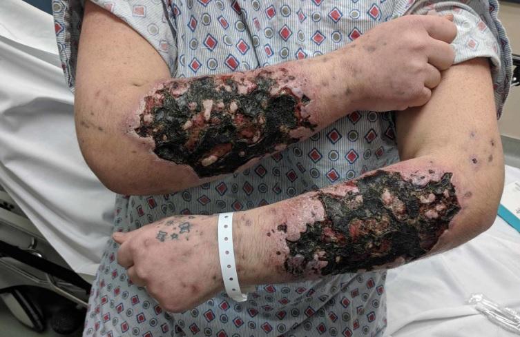 The term "Zombie Drug Wounds" is sometimes used colloquially to describe the visible physical effects that krokodil use can have on a person's skin and flesh. 
