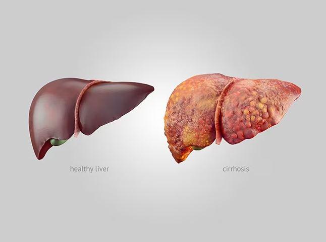 Alcoholic cirrhosis can impair the liver's ability to produce clotting factors, increasing the risk of bruising and bleeding from minor injuries.